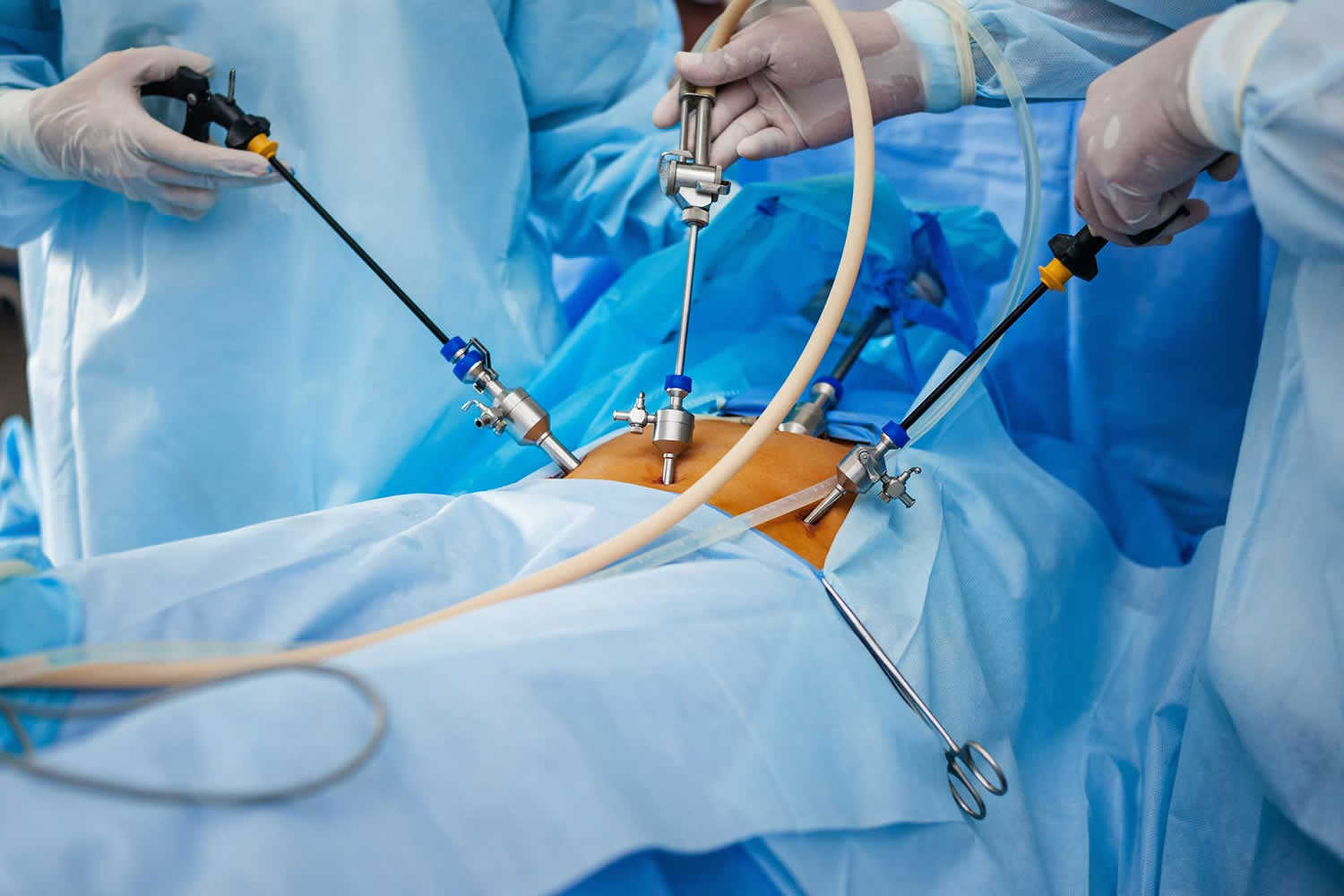 Laparoscopic Surgery in Dubai