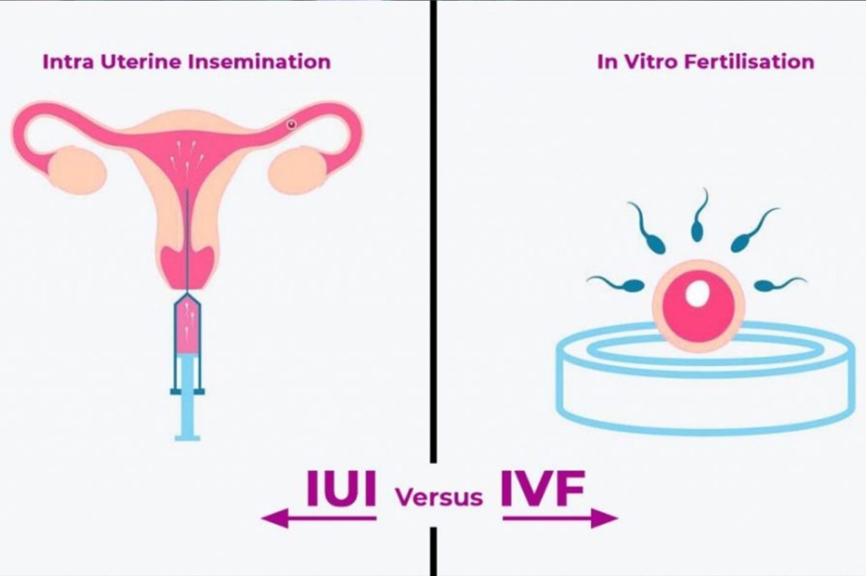 IVF Vs Artificial Insemination