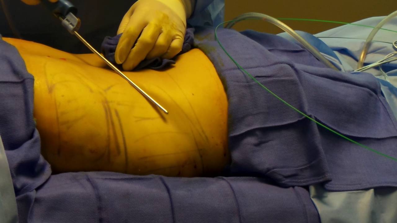 Liposuction Dubai Silicon Oasis