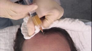 Can a Hair Transplant Bring Back a Full Head of Hair?