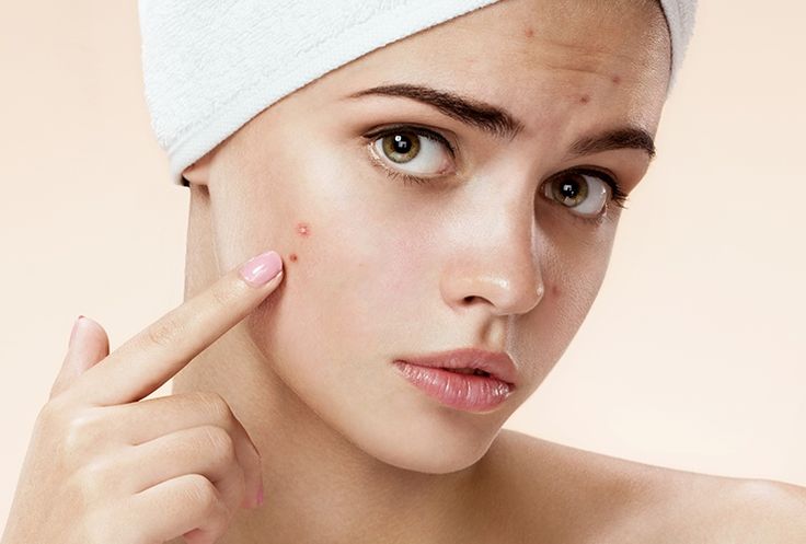Pimples treatment in Islamabad