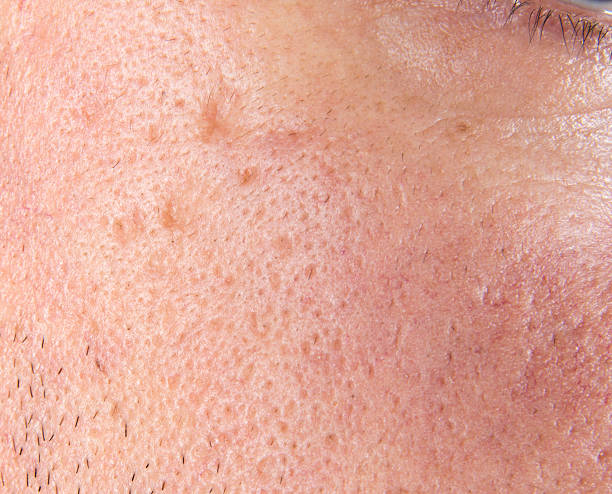 Large Pores Treatment