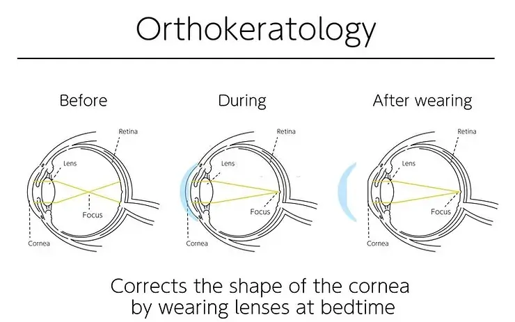 Orthokeratology