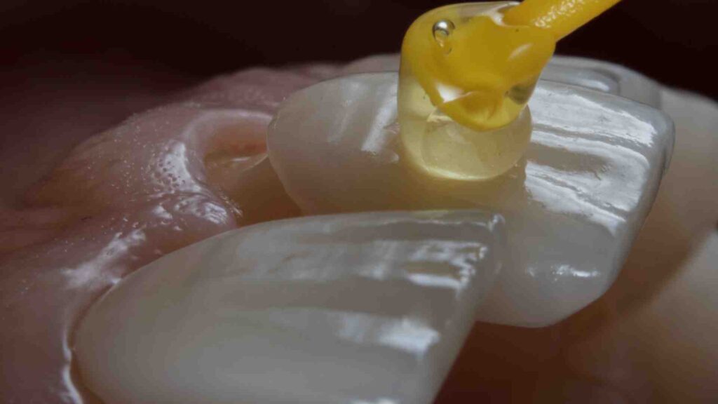 Comment entretenir ses facettes dentaires sur le long terme ?