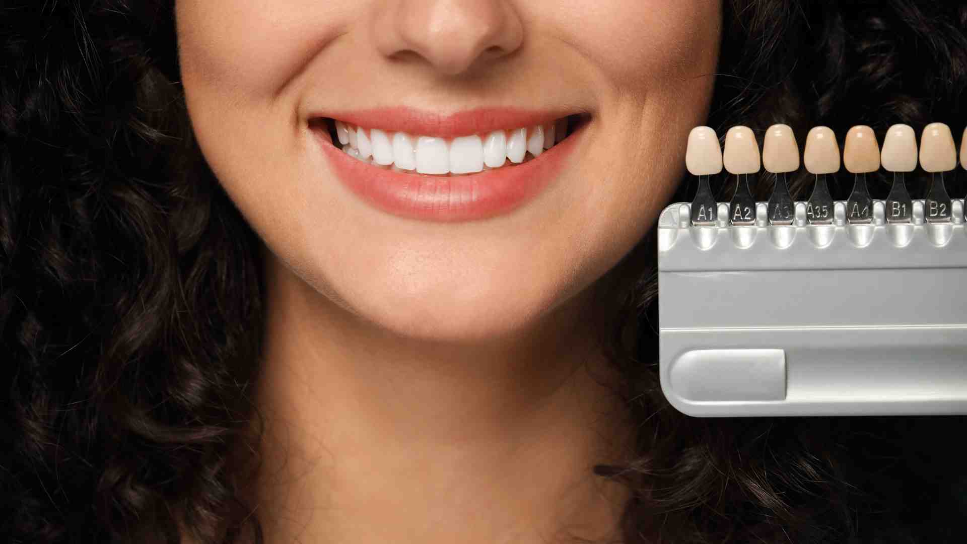 Conseils importants avant la pose d’une facette dentaire