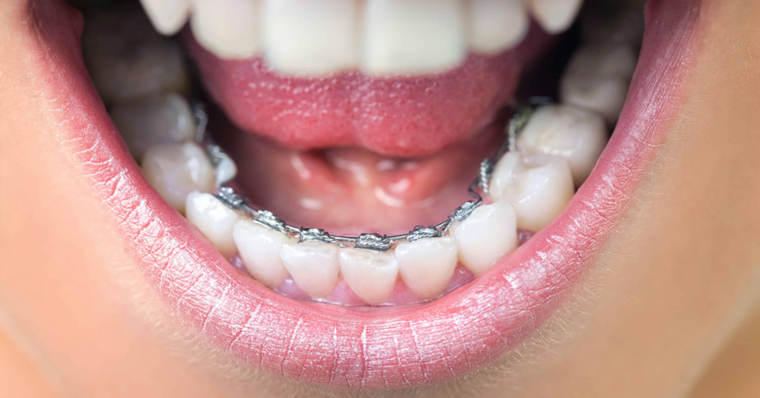 Metal Braces and Oral Hygiene Keeping Your Teeth Healthy