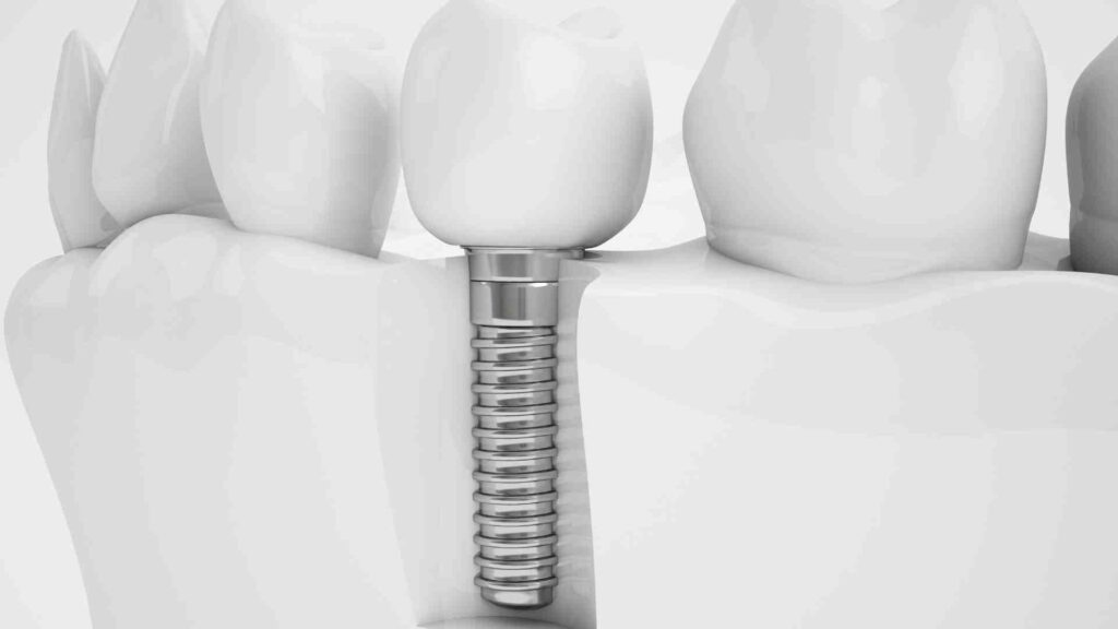 Step-by-Step: What Happens During Dental Implant Surgery