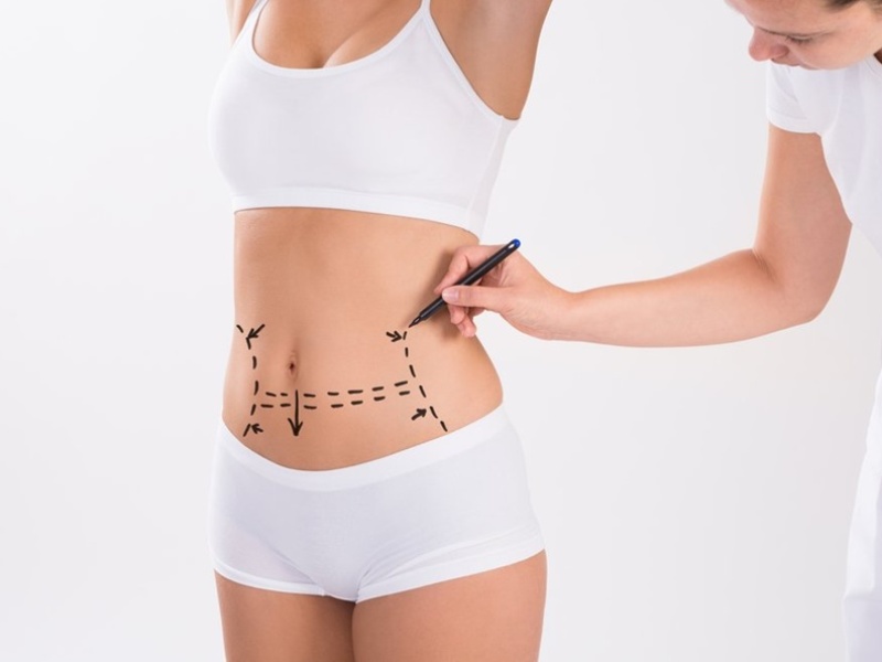 Tummy Tuck in Islamabad.pk
