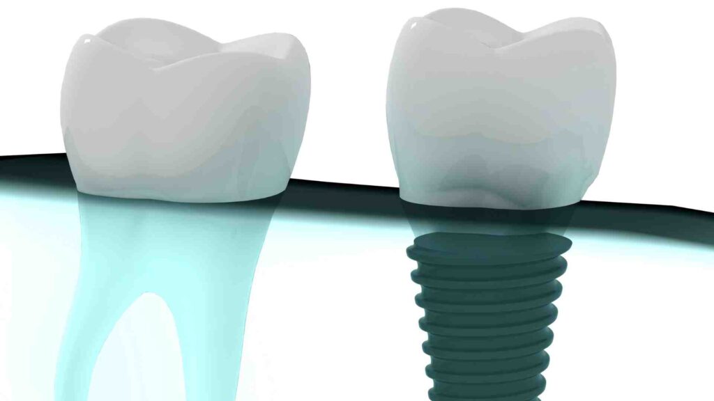 What Happens After the Implant?