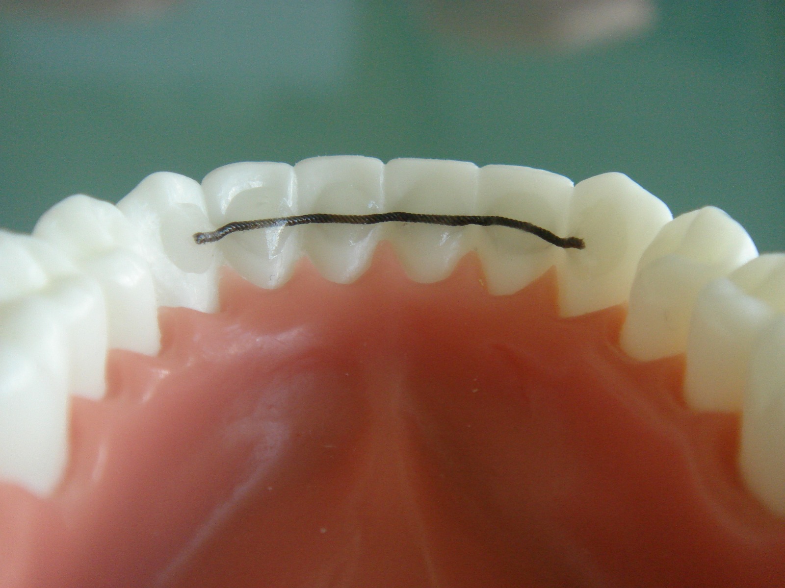 What to Expect During Your First Retainer Fitting Appointment