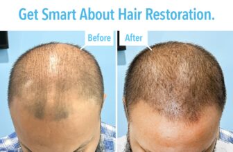 Hair restoration in Lauderdale Beach
