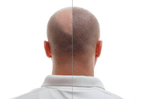 Are Hair Transplants Worth It?