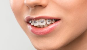 Is Your Child Ready for Metal Braces A Parent’s Checklist