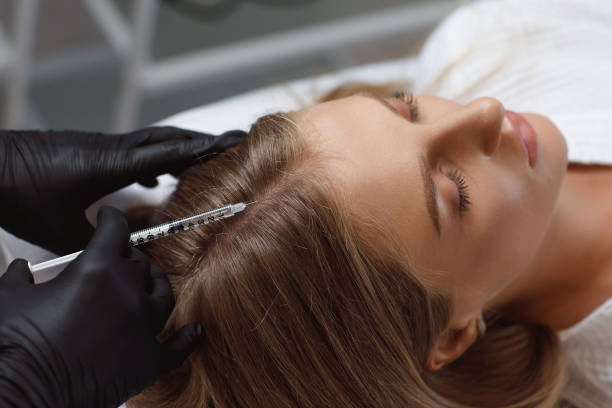 PRP hair treatment in Dubai