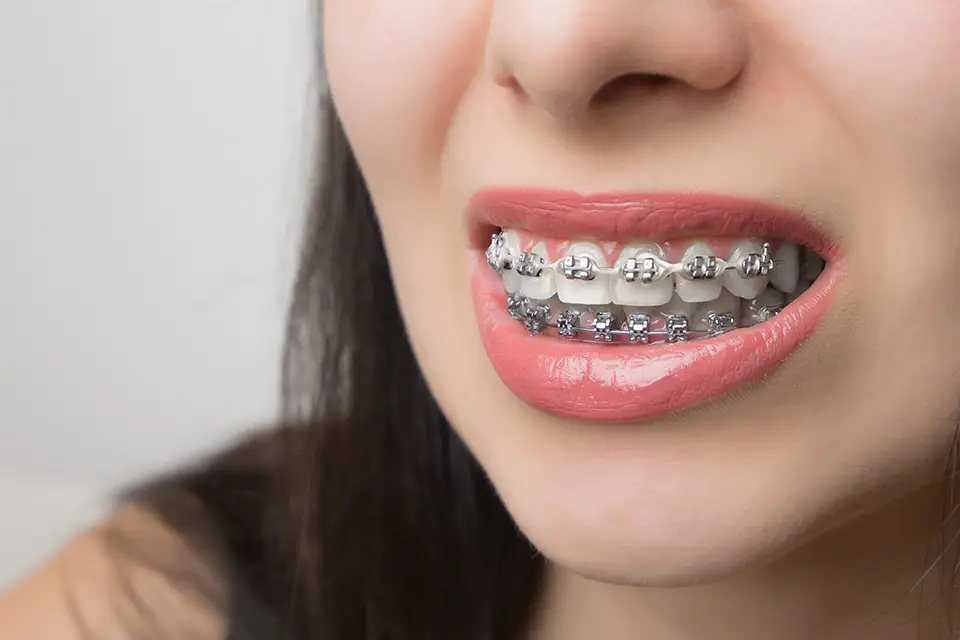 The Impact of Braces on Facial Structure and Appearance