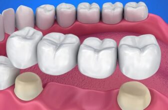 Choosing Durability: Zirconia vs Ceramic for Molars