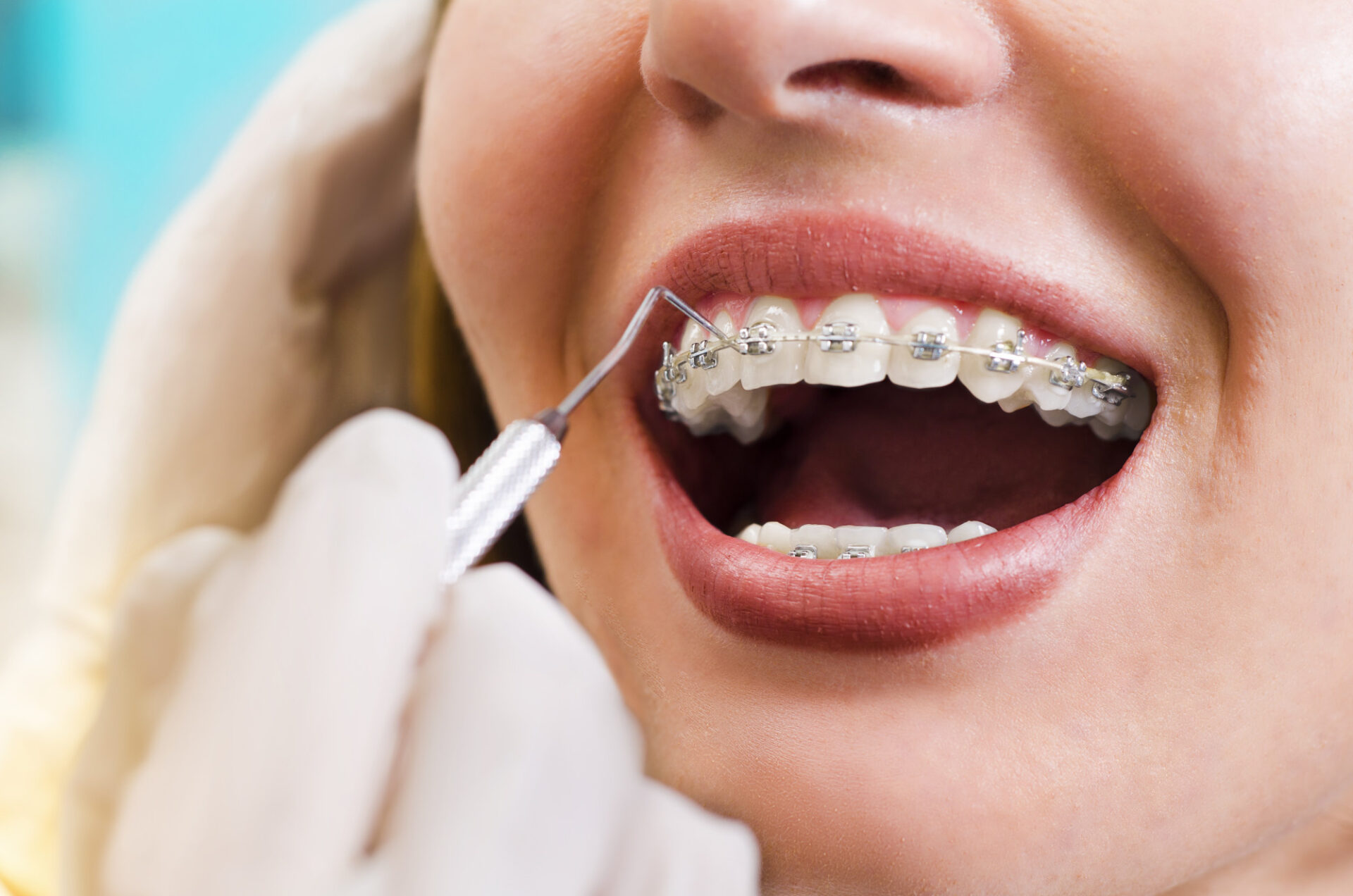 The Role of Braces in Correcting Bite Problems