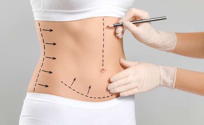 liposuction in Islamabad