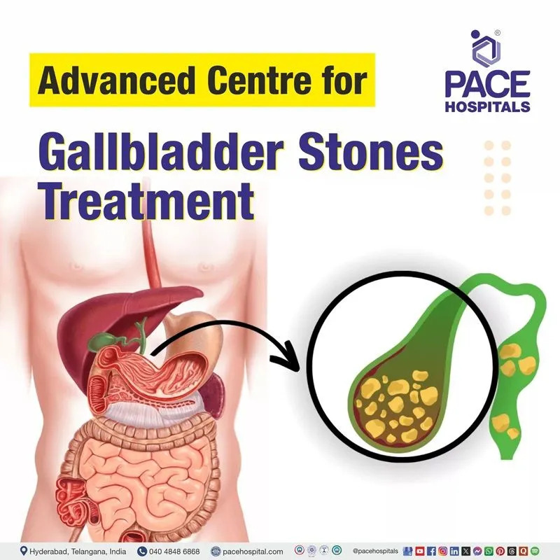 Gallstone Treatment