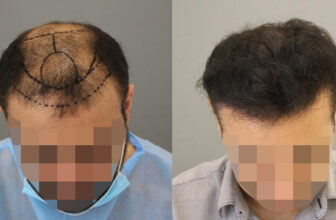 زراعة الشعر في الرياض