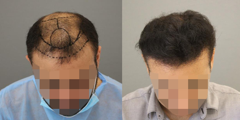 زراعة الشعر في الرياض