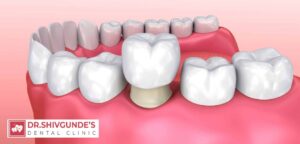 Dental Crown in Solapur — Expert Treatment by Trusted Cosmetic Dentists