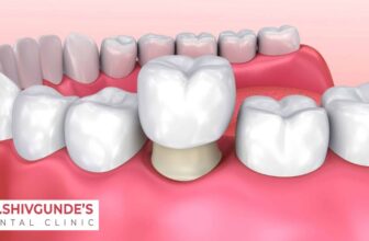 Dental Crown in Solapur — Expert Treatment by Trusted Cosmetic Dentists