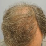 Understanding Hair Transplant: A Permanent Solution for Hair Loss
