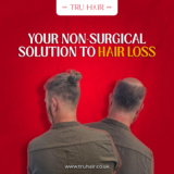 Hair Loss in Men: More Than Just a Bad Hair Day.