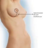 Breast Lift Surgery in Mumbai – Enhance Your Confidence with Dr. Amiti Shah