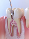 Single-Sitting Root Canal Treatment: Is It Suitable for Complex Cases?