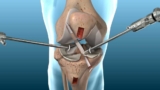 The Role of Physiotherapy in ACL Ligament Surgery in Jaipur