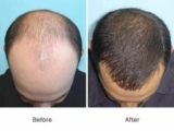 Affordable Hair Replacement in Dubai What You Need to Know