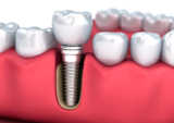 Are Dental Implants Right for You? A Comprehensive Assessment Guide