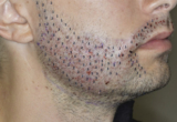Are There Any Long-Term Side Effects of Beard Hair Transplants in Dubai