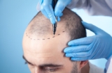 How Does Hair Transplant Treatment Transform Your Appearance?