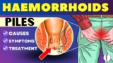 Your Search Ends Here: Best Piles Treatment in Delhi Revealed