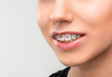Best Teeth Alignment Treatment in Otteri, Chennai