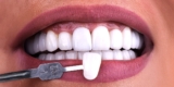 Bright, White, and Stress-Free: Aesthetic Benefits of Non-Prep Veneers