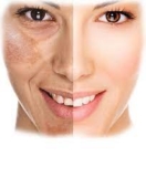 Can Pigmentation Treatments in Dubai Help with Melasma