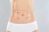 Can a Tummy Tuck in Dubai Help Me Get Rid of Loose Skin After Weight Loss