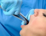Best Tooth Extraction Services in Nambour | Smile Nambour