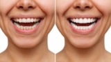 10 Things You Should Know Before Getting Composite or Porcelain Veneers.