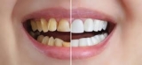 Best Cosmetic Dental Treatments for Gaps and Misaligned Teeth