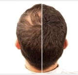 اختيار زراعة الشعر التاجى المناسب في دبي
