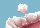 Decoding Dental Crown Options