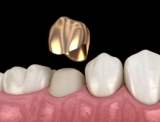 What Factors Affect the Tooth Removal Cost in Victor Harbor?