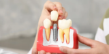 Dental Implants and Your Daily Routine