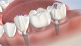 Confident Smiles Start Here: Discover the Benefits of Dental Implants