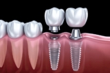 Prosthetic Teeth Maintenance Tips for Long-Lasting Durability and Comfort